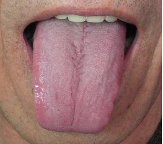 Square-shape tongue