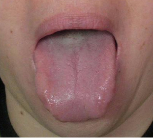 Closed bag-shaped tongue