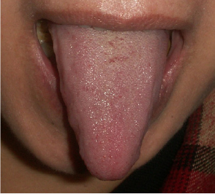 Stick-shape tongue