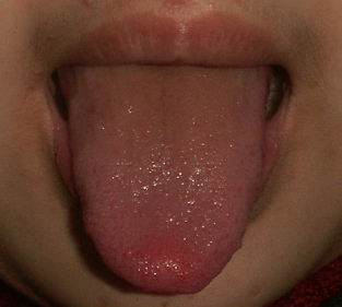 Bumps at the tip of the tongue