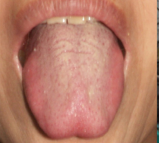 Whole tongue raising