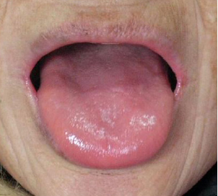 No coating (mirror tongue)