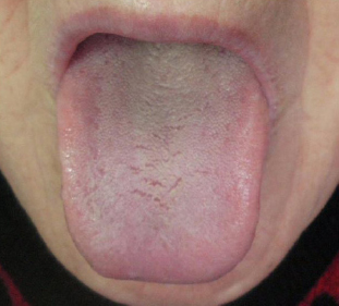 Large and hard tongue