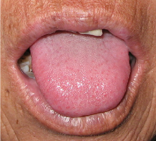 Small and soft tongue