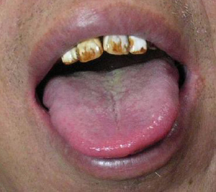Small and hard tongue