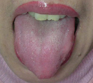 Peach-shape tongue