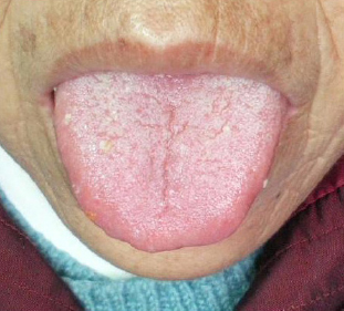 Dry tongue